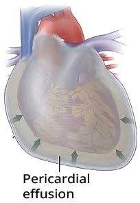 Electrical QRS alternans, massive pericardial effusion, Pericarditis