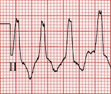 ECG Wide QRS complex, QRS duration greater than 120ms