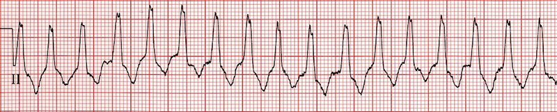 ECG Differential Diagnosis (DDx) of Wide-Complex Tachycardia, Brugada Stuerer algorithm (VT vs. Pre-excited SVT)