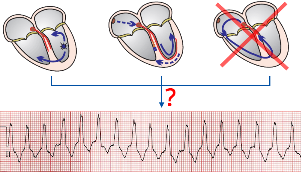 R Wave Peak Time RWPT, VT vs SVT with aberrancy