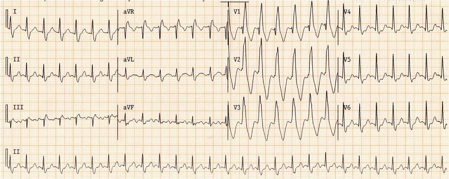 Griffith (Bundle Branch Block) algorithm, DDx broad complex tachycardia, RBBB morphology - YES, SVT with RBBB