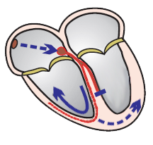 supraventricular tachycardia, LBBB morphology