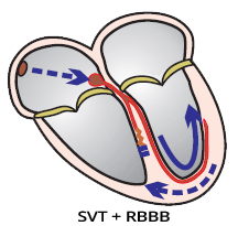 Supraventricular tachycardia with RBBB (wide complex tachycardia)