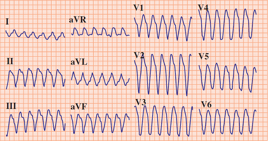 ECG wide QRS complex tachycardia (ventricular tachycardia), Griffith (Bundle Branch Block) algorithm