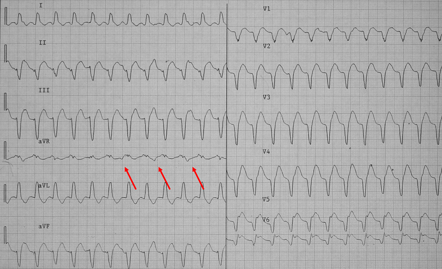 Griffith criteria, SVT with LBBB morphology, AV dissociation, ventricular tachycardia