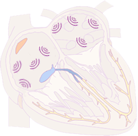 atrial fibrillation, micro re-entry mechanism, supraventricular tachycardia (SVT) arrhythmia