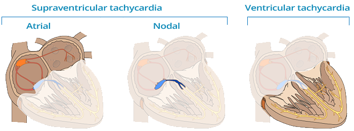 Supraventricular (Atrial, Nodal) tachycardia, Ventricular tachycardia