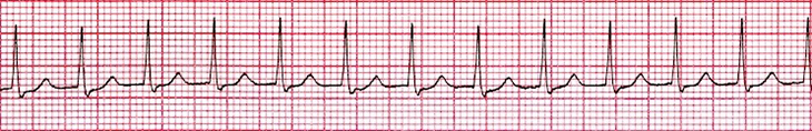 ECG Atrioventricular Nodal Reentry Tachycardia (AVNRT), re-entry of AV junction, supraventricular tachycardia (SVT) arrhythmia
