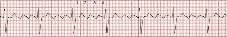 ECG atrial flutter, macro re-entry, supraventricular tachycardia (SVT) arrhythmia