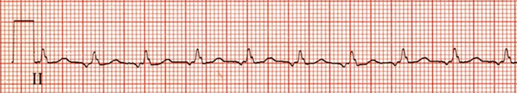 ECG ectopic atrial tachycardia, enhanced normal automaticity, supraventricular tachycardia (SVT) arrhythmia