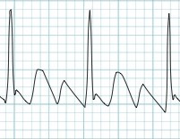 ECG narrow complex tachycardia, atrial flutter