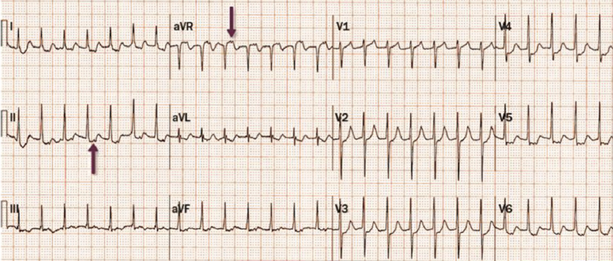 ECG short RP interval supraventricular tachycardia, lon RP interval, Ortodromic AVRT