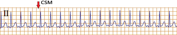 ECG narrow complex QRS tachycardia, carotid sinus massage, SA nodal reentry tachycardia
