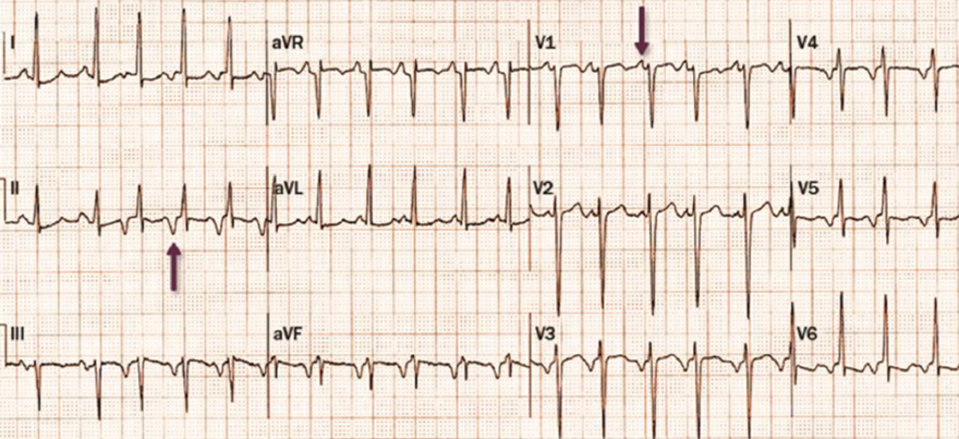 ECG narrow complex tachycardia, Long RP tachycardia, Permanent junctional reciprocating tachycardia in children