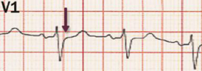 ECG sinus rhythm, no pseudo r wave