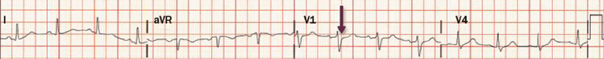 ECG sinus rhythm, after massage carotid sinus