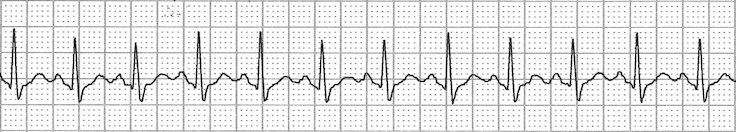 ECG sa node reentry, Sinoatrial nodal reentrant tachycardia (SANRT)