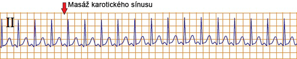 ECG SA node reentry, carotid sinus massage, Sinoatrial nodal reentrant tachycardia (SANRT)