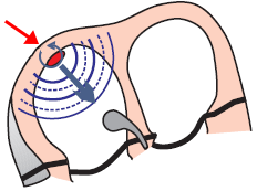 SA node reentry, Sino-atrial nodal reentrant tachycardia (SANRT)