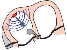 SA node, atria, sinus tachycardia, enhanced automaticity