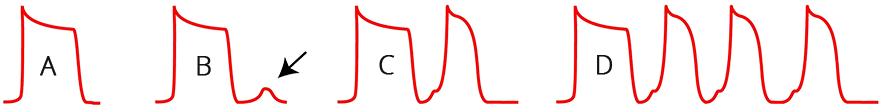 Delayed afterdepolarization induced Triggered activity, action potential, single triggered AP, multiple triggered APs