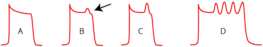 Mechanism early after-depolariziation, phenomenon R on T, Torsades de Pointes