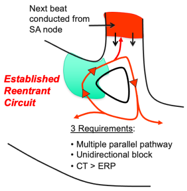 Established reentrant circuit, multiple parallel pathways, unidirectional block, slow and fast pathway