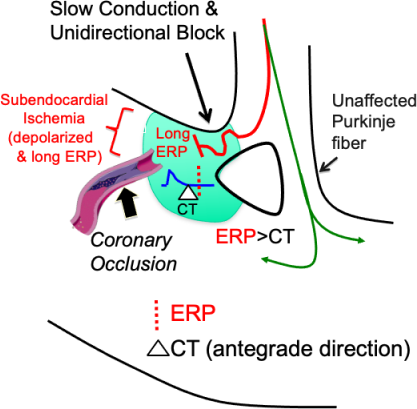 Subendocardial ischemia, slow conduction, unilateral block, coronary occlusion, unaffected Purkinje fiber