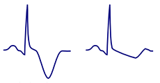 ECG abnormal disconcordance T wave, positive QRS, negative inverted T wave