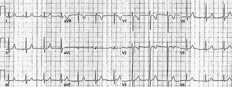 ECG (V1-V3) persistent juvenile T wave pattern (PJTWI), Benign T wave inversion (BTWI), assymetric T wave inversion