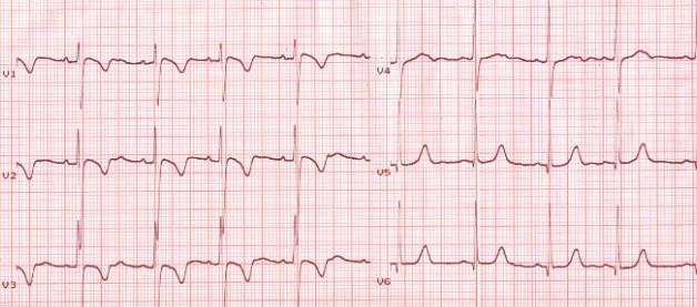 ECG (V1-V3) persistent juvenile T wave pattern (PJTWI)