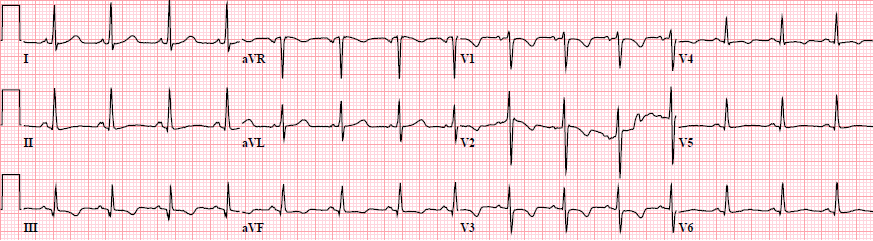 ECG (V1-V4) persistent juvenile T wave pattern, african-american female