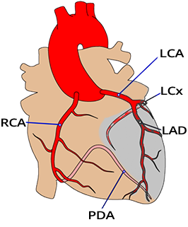 Heart stenosis: Circumflex branch of left coronary artery (LCx), Anterior interventricular branch of left coronary artery (LAD)