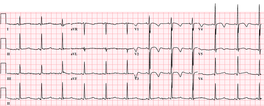 ECG T wave inversion, hyperventilation