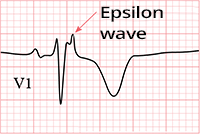 ECG epsilon wave, inverted T wave