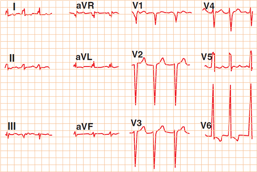 ECG triad of congestive heart failure: Low QRS voltage (limb leads), High QRS volate (precordial leads), Poor R wave progression